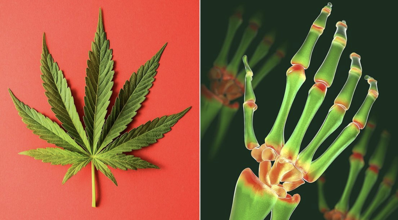 Treating Pain with Cannabis